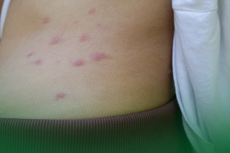 Bed Bug Bites Symptoms Bed bug bites